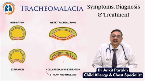 Tracheomalacia - Symptoms, Causes, Diagnosis, Treatment - Hello…