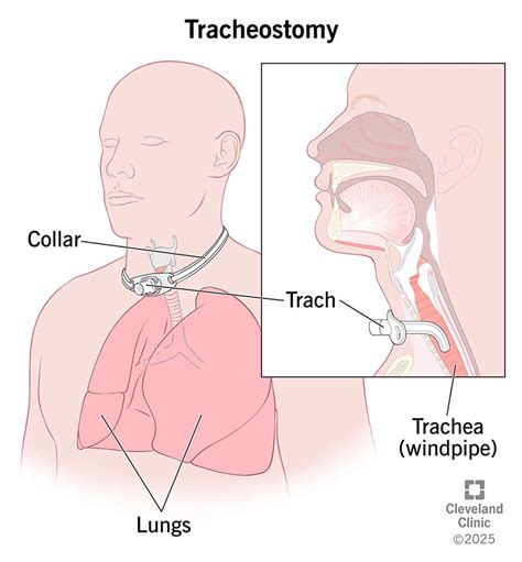 Tracheotomy Purpose preparation what to expect