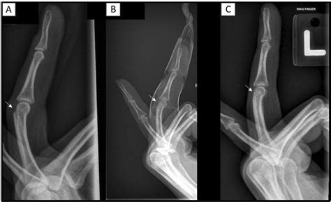 Traction Orthosis for Oblique Proximal Phalangeal Fractures