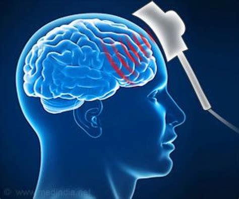 Transcranial Magnetic Stimulation (TMS) - Choosing Therapy