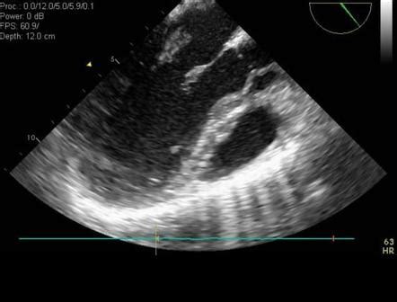 Transesophageal echocardiography Radiology Reference …