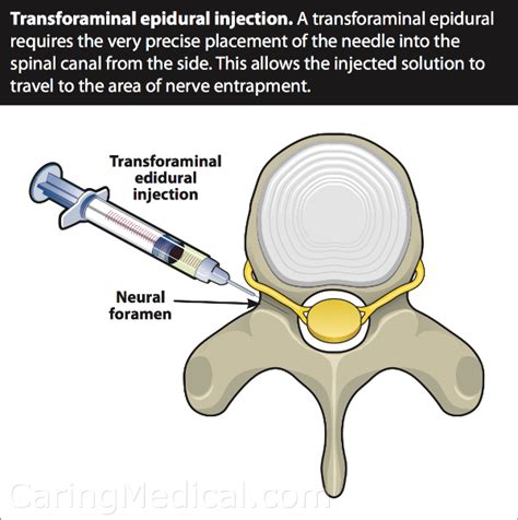 Transforaminal Epidural Injections - Medical Clinical Policy