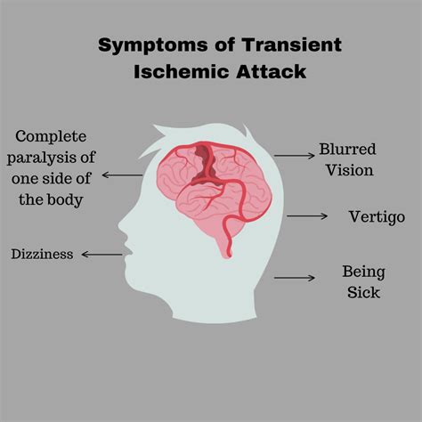 Transient Ischemic Attack