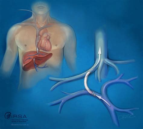 Transjugular intrahepatic portosystemic shunt (TIPS) for severe veno …