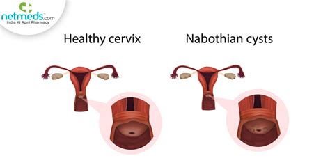 Translate nabothian cyst in Tagalog with examples