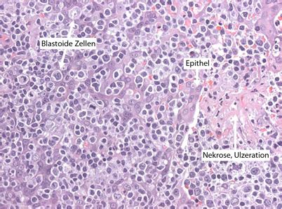 Transplantationsassoziierte lymphoproliferative …