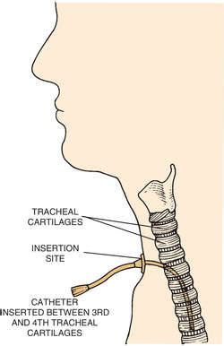 Transtracheal Definition & Meaning Merriam-Webster Medical