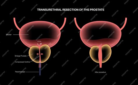 Transurethral Prostatectomy (TURP) & Open - Queensland Health