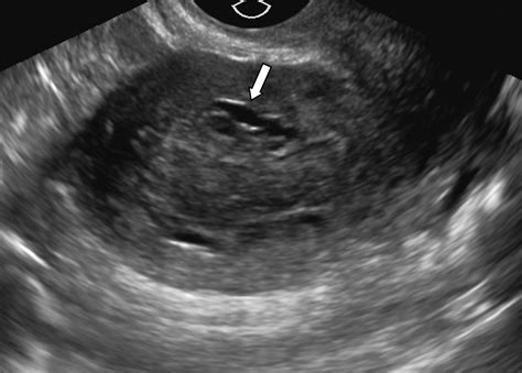 Transvaginal sonography in the diagnosis of adenomyosis: which …