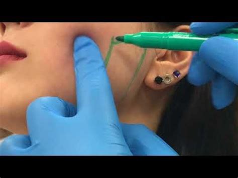 Treating enlarged masseter muscles with Botox by Dr. Shaun Patel