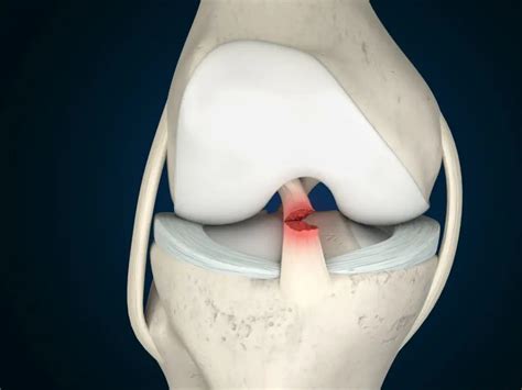 Treatment for acute anterior cruciate ligament tear: five year …