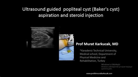 Treatment of Popliteal (Baker) Cysts With Ultrasound-Guided …