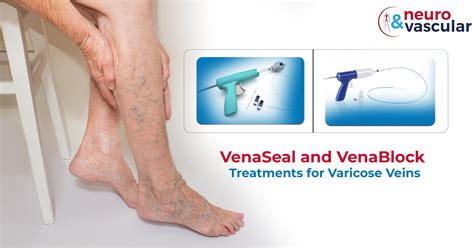 Treatment of Varicosed Tributary Veins - ScienceDirect