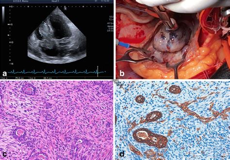 Treatment of cardiac synovial sarcoma: experience of two cases