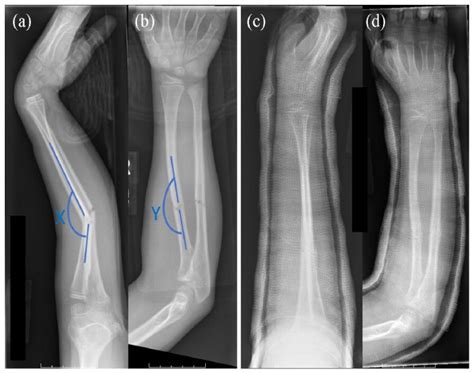 Treatment of forearm fractures - PubMed