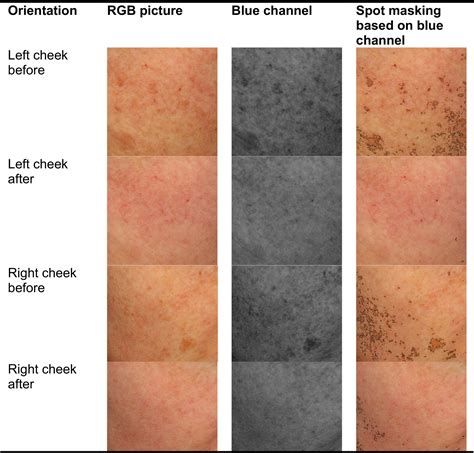 Treatment of solar lentigines - ScienceDirect