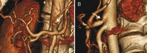 Treatment options and outcomes for celiac artery compression syndrome