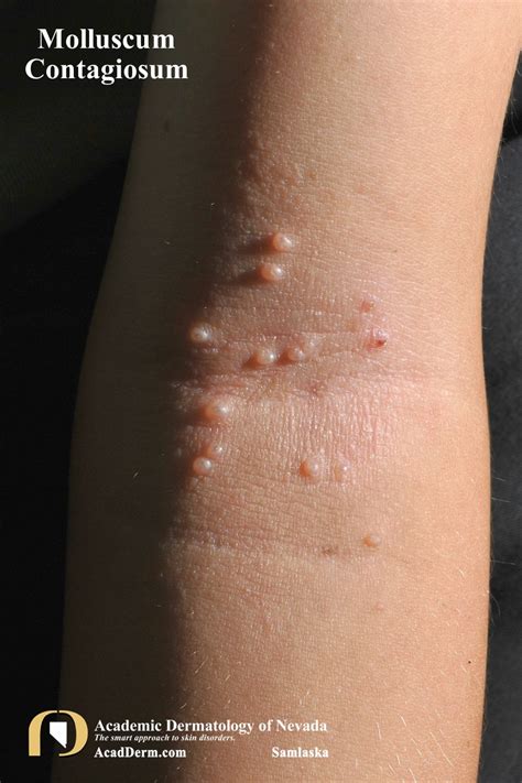 Treatments for molluscum contagiosum, a common viral skin …