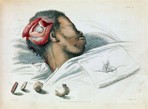 Trepanation - RationalWiki