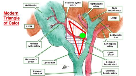 Triangle Of Calot Critical View