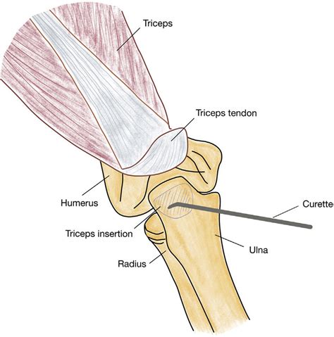 Triceps Repair and Restoration of Triceps Footprint With …