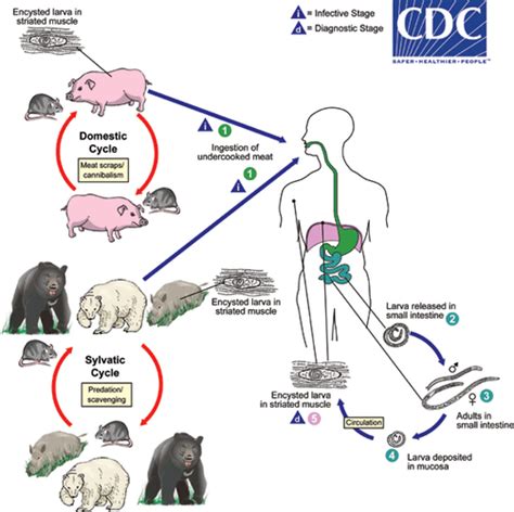 Trichinosis Infection - DoveMed