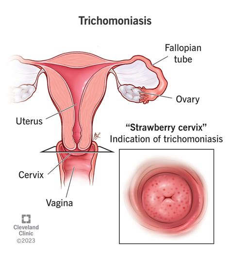 Trichomoniasis causes miscarriages.  B.  May 7, 2024 · Trichomoniasis is a...