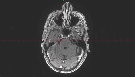 Trigeminusneuralgie Therapie: Behandlungsoptionen im …