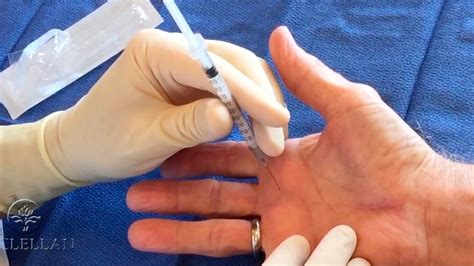 Trigger Finger Injection Technique - YouTube