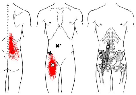 Trigger Points in the Psoas Muscles (Groin Pain)