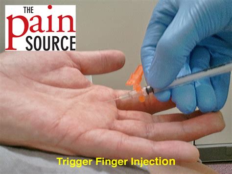 Trigger finger injection cpt. Things To Know About Trigger finger injection cpt. 