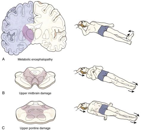 Triple flexion response brain death.  Flexion Undulating toe flexion sign, triple fle...