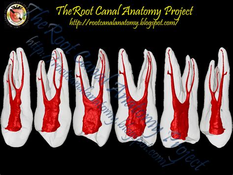 Tripled rooted maxillary 1st premolar. #acteon #dental #home_free