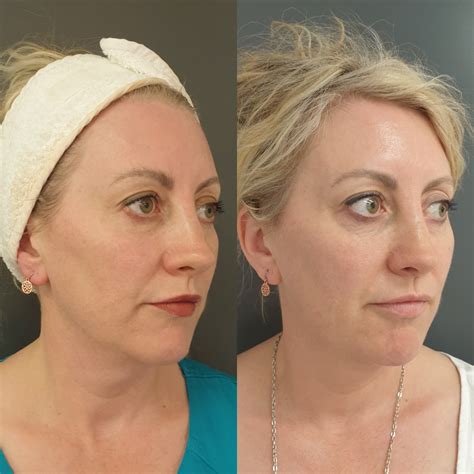 Trisculpt before and after. Things To Know About Trisculpt before and after. 