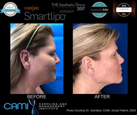 Trisculpt ex before and after. Sono Bello review: Lipo & trisculpt ex disaster. Here's an outline the misinformation and frankly the borderline negligence that I have experienced with some of the sales staff and Dr. Alison. (This is all from a follow up email to the VA office a month ago, I was told that I'd hear back from the team) I have followed up, no response, ridiculous! 