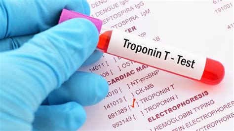 Troponin Yüksekliği Ne Anlama Gelir? Troponin seviyesindeki hafif bir yükselme bile genellikle kalbin hasar aldığını gösterir.