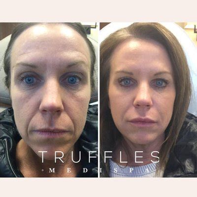 Truffles Medispa