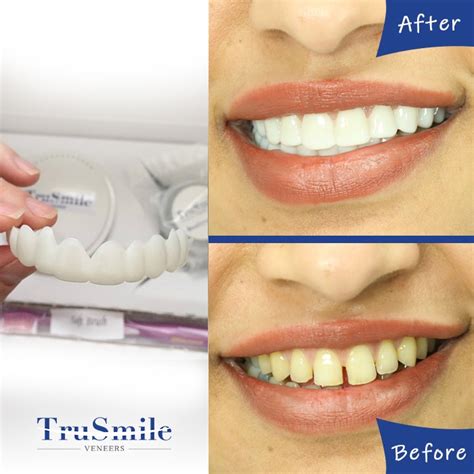 Trusmile veneers reviews. They instantly clip on your existing teeth for a bold and confidence-boosting smile for years to come. TruSmile veneers come at a highly affordable price of $499. You'll also say goodbye to painful, expensive, and time-consuming dentist visits to fix missing, broken, or stained teeth with this dental treatment option. 