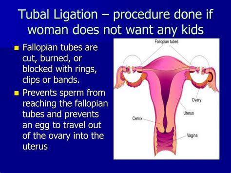 Tubal ligation - Mayo Clinic - Mayo Clinic