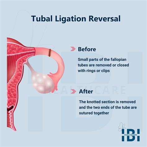 Tubal reversal surgery north carolina. A Personal Choice Tubal Reversal Center is in Raleigh, North Carolina and specializes in tubal ligation, Essure, and vasectomy reversal surgery. Dr. Monteith specializes in helping couples have more beautiful children with reversal surgery and helping women treat abnormal symptoms after their tubes have been tied! 