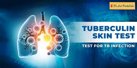 Tuberculin Test Introduction, Procedure, Normal Range and Result Interpr