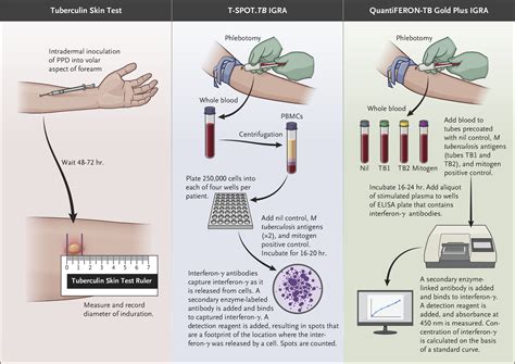 Tuberculosis TB Testing - InOut Labs