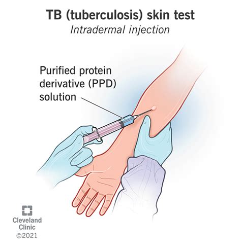Tuberculosis test near me walgreens. A tuberculosis test can be performed on the skin or in the blood. Neither test necessitates any extra preparation. During the skin test, the TB test provider injects a small protein called PPD beneath the first layer of your skin. A positive reaction to PPD, which is generated from tuberculosis bacteria, can indicate that you have had tuberculosis. 