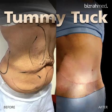 Tummy tuck spokane.  [Informal.  tum&middot;mies Informal 1.  pl. , pl.  2.  The human torso (Defin...