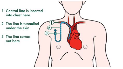 Tunneled Central Lines (Discharge Care) - Drugs.com