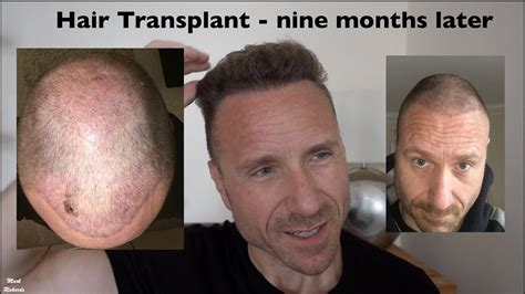 Turkey hair transplant reddit. Medications like Finasteride (Propecia) and Dutasteride, suppress DHT by 70-90% and allow that remaining hair to not thin and stop growing. Unfortunately, there is a lot of bad press about the two medications, because 1-2% of men who take it, can experience side effects like loss of Libido and Erectile Disfunction. 