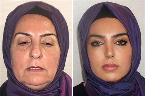 Here are some approximate price ranges for common plastic surgery procedures in Turkey: Rhinoplasty (Nose Job): Prices can range from $2,000 to $5,000. Breast Augmentation: Prices typically range from $2,500 to $5,000.. 