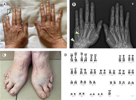 Turner short 4th metacarpal sign in page