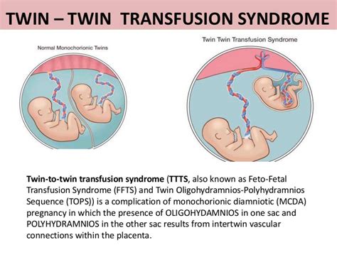 Twin-to-Twin Transfusion Syndrome: Symptoms & Outcome - Cleveland Clinic