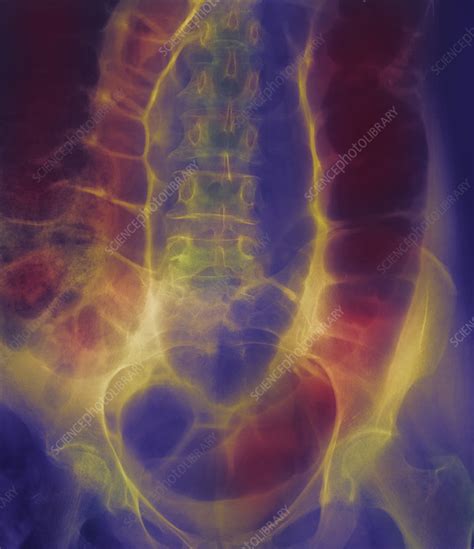 Twisted colon Stock Image M290/0118 Science Photo Library